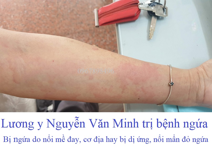 Lương y Nguyễn Văn Minh trị bệnh ngứa